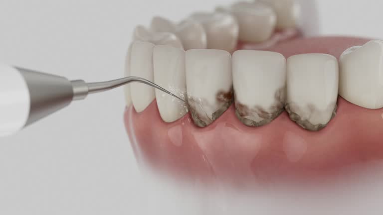 Reliable Tooth Extraction contractor in Fair Oaks, GA by Smile Center Dentistry